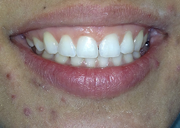 Pasadena Dentist, Cosmetic Dentistry, Invisalign Orthodontics 91105