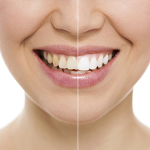 teeth whitening in pasadena